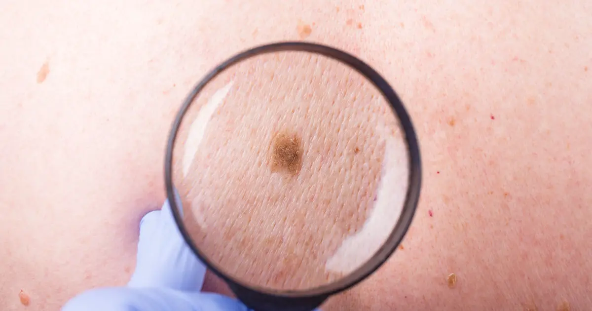 Rashes Can Be A Sign Of Pores And Skin Most Cancer: How To Become Aware Of Those Signs And Symptoms, Consult Doctor To Realize Which Humans Are More In Chance
