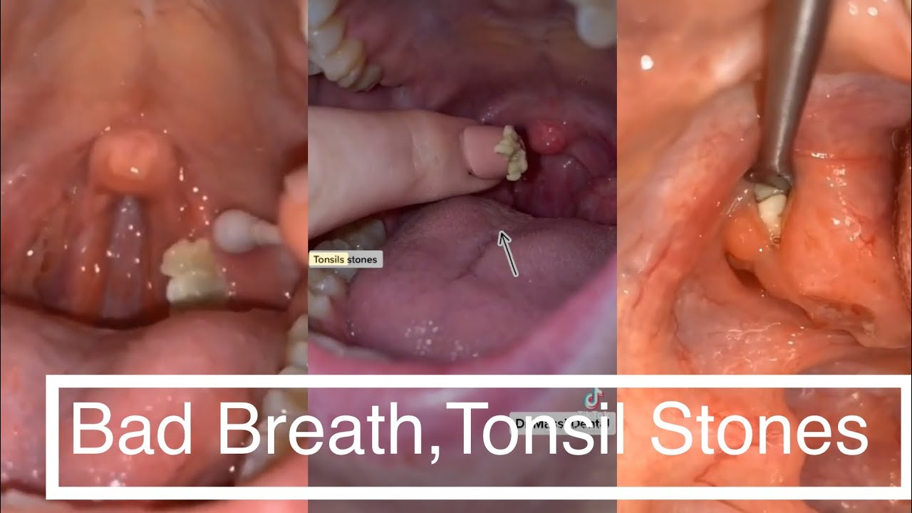 Tonsil Stones: Causes, Symptoms, And Treatment Options
