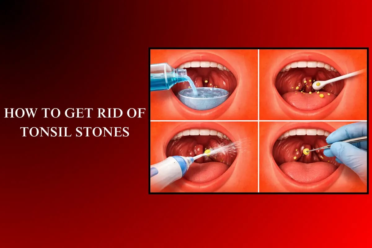 What Is The Treatment For Throat Stones? Know The Symptoms, Causes, Prevention, And Treatment Of Tonsil Stones