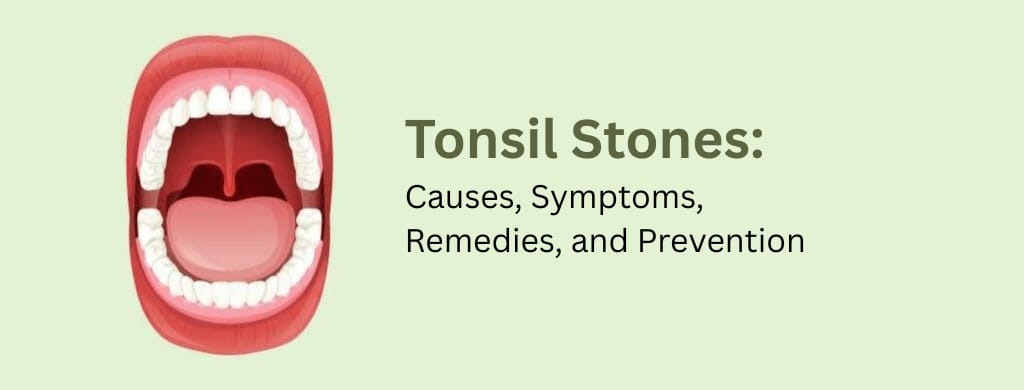 Symptoms, Causes, And Treatment Of Tonsil Stones