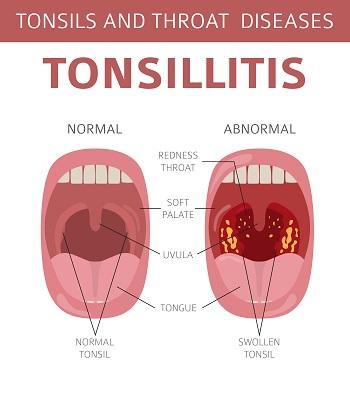 What Is Tonsillitis? Symptoms, Causes, Treatment, And Home Remedies